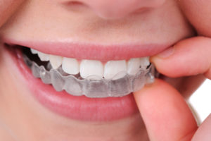 putting invisible aligner on teeth